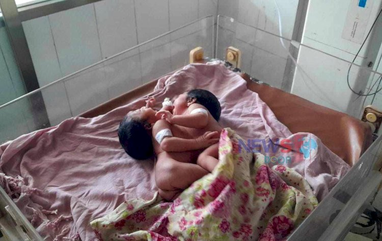রংপুরে বুক-পেট জোড়া লাগা যমজ শিশুর জন্ম